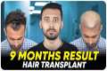 Hair Transplant in Spain | Best