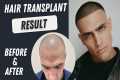 Hair Transplant Before and After | 