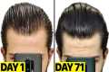 My INSANE Finasteride & Minoxidil 