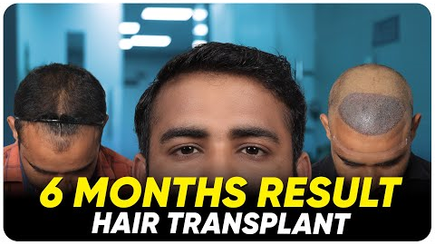 Hair Transplant in Vijayapura | Best Results & Cost of Hair Transplant in Vijayapura