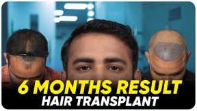 Hair Transplant in Vijayapura | Best Results & Cost of Hair Transplant in Vijayapura