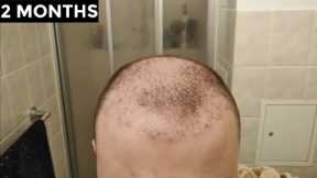 My 2 Hair Transplants Results Timeline | Before and After