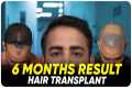 Hair Transplant in Vijayapura | Best