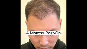 Hair Transplant Timeline 0-12 Months-Bogota Hairlines