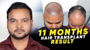 Hair Transplant in Bangkok | Best Results & Cost of Hair Transplant in Bangkok