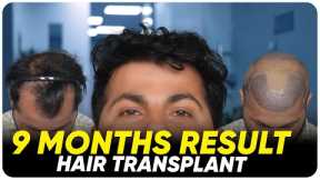 Hair Transplant in Salem | Best Results & Cost of Hair Transplant in Salem