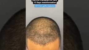 15 DAY TRANSFORMATION: See His Hair Before and After Sapphire FUE Hair Transplant