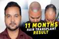 Hair Transplant in Bangkok | Best