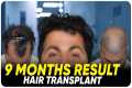 Hair Transplant in Salem | Best