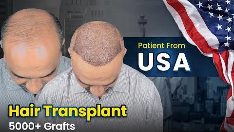 Patient Travelled from the USA to India for Hair Transplant Surgery #hairtransplant