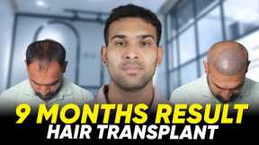 Hair Transplant in Coimbatore | Best Results & Cost of Hair Transplant in Coimbatore