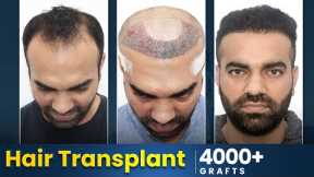 Best Hair Transplant in Vizag | Amazing Hair Transplant Results & Cost in Vizag #hairtransplant