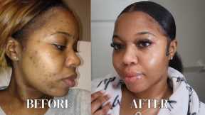 HOW I CLEARED MY ACNE & DARK SPOTS | 2025 UPDATED GLASS SKINCARE ROUTINE