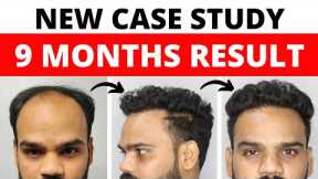 My Hair Transplant Result After 9 Months