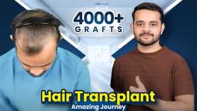 Best Hair Transplant in Bangalore | Amazing Results & Cost of Hair Transplant in Bangalore