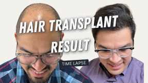 Hair Transplant Result | Hair Transplant Before and After | Hair Transplant in Turkey Time lapse