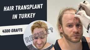 Hair Transplant Before and After Operation | 4300 Grafts Hair Transplant | Hair Transplant in Turkey