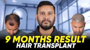 Hair Transplant in Istanbul | Best Results & Cost of Hair Transplant in Istanbul