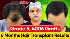 Shocking Hair Growth Results in India (4006 Grafts, Norwood Grade 5) | Hair Transplant Cost