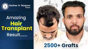 Grade 3 Hair Transplant in Nagpur | Best Hair Transplant Results & Cost in Nagpur #hairtransplant