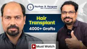 Grade 7 Hair Transplant in Surat | Stunning Hair Transplant Results and Best Cost in Surat