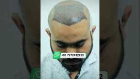 Best Hair Transplant Surgery in India | Hair Transplant Before and After #hairtransplant #shorts