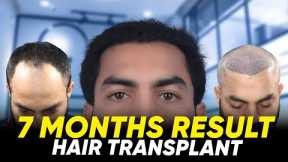 Hair Transplant in Perth | Best Results & Cost of Hair Transplant in Perth