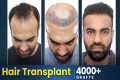 Best Hair Transplant in Vizag |