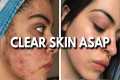 Clear Your Skin: The Ultimate Acne