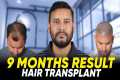 Hair Transplant in Istanbul | Best