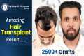 Grade 3 Hair Transplant in Nagpur |