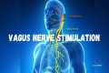 Vagus Nerve Stimulation