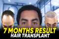 Hair Transplant in Perth | Best