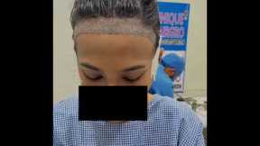 Female Hair transplant | Unique Hair grow Chennai | best hair transplant in chennai