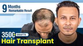 Grade 5 Hair Transplant in Bangalore | Amazing Hair Transplant Results & Cost in Bangalore