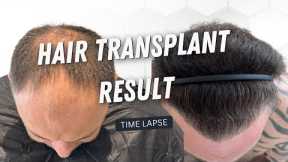 Hair Transplant 5200 Grafts Before and After | Hair Transplant  Time Lapse | Hair Transplant Result