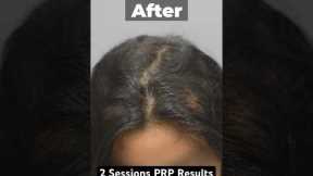 PRP Results Before & After 2 Sessions  #prptreatment #hairlosstreatment