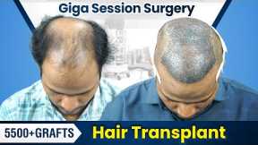 Giga Session Hair Transplant in Pune | Hair Transplant Results & Cost in Pune #hairtransplant