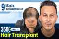 Grade 5 Hair Transplant in Bangalore