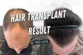 Hair Transplant 5200 Grafts Before