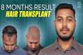 Hair Transplant in Vellore | Best