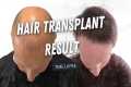 Hair Transplant 5000 Grafts Before