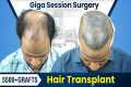 Giga Session Hair Transplant in Pune