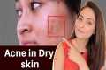 Acne in Dry Skin | what to use |