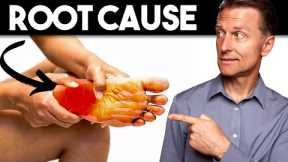 Peripheral NEUROPATHY (Root Cause and Best Remedy) — Dr. Berg