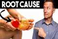 Peripheral NEUROPATHY (Root Cause and 