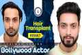 Celebrity Hair Transplants: Salman