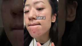 😲 GAMECHANGING combination to getting rid of cystic acne breakouts fast! #shorts