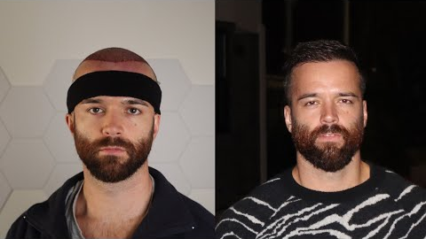My 6 Month Hair Transplant Update