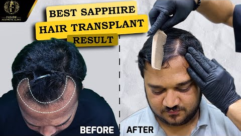 Best Sapphire FUE Hair Transplant Results (Time Lapse) Dr.Pranil More